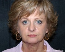 Before facelift front view female patient case 2882