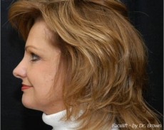 After facelift left side view female patient case 2882