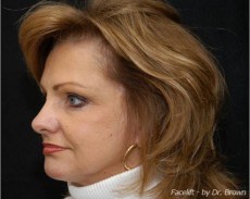 After facelift left angle view female patient case 2882