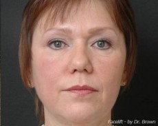 before facelift front view female patient case 2890