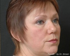 before facelift right angle view female patient case 2890