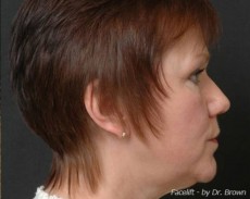 before facelift right side view female patient case 2890