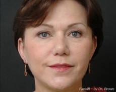 after facelift front view female patient case 2890