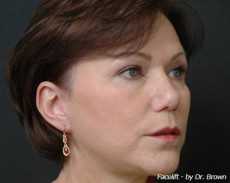 after facelift right angle view female patient case 2890