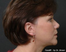 after facelift right side view female patient case 2890