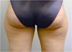 before liposuction front view of female patient 2934