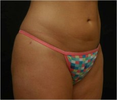 after liposuction right angle view of female patient 2937