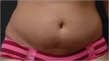 before liposuction front view of female patient 2941