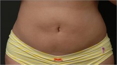 after liposuction front view of female patient 2941
