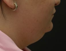 before neck lift right side view female patient case 2911