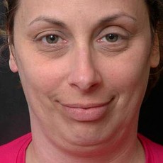 before neck lift front view of female patient 2914