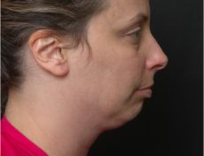before neck lift right side view of female patient 2914