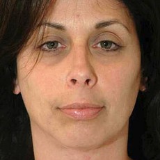 after neck lift front view of female patient 2914