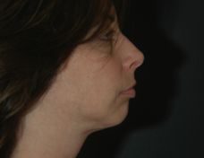 after neck lift right side view of female patient 2914