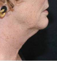 before neck lift right side view of female patient 2919