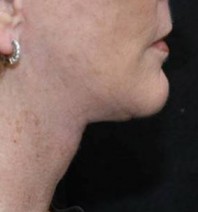 after neck lift right side view of female patient 2919