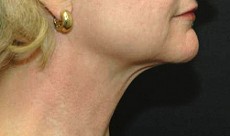 before neck lift right side view of female patient 2922