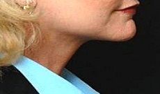 after neck lift right side view of female patient 2922