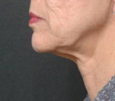 before neck lift left side view female patient case 2925