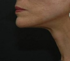 after neck lift left side view female patient case 2925