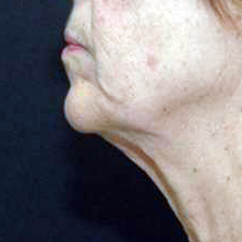 before neck lift left side view of female patient 2928
