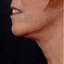 after neck lift left side view of female patient 2928