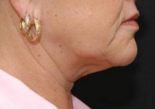 before neck lift right side view of female patient 2931