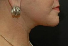 after neck lift right side view of female patient 2931