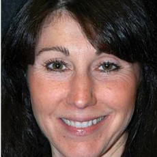 before rhinoplasty front view of female patient 2951