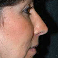 before rhinoplasty right side view of female patient 2951