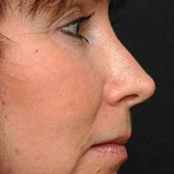 after rhinoplasty right side view of female patient 2951