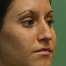 before rhinoplasty right angle view of female patient 2956