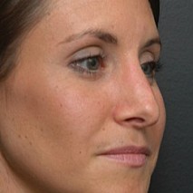 after rhinoplasty right angle view of female patient 2956