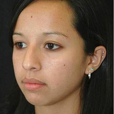 before rhinoplasty left angle view of female patient 2959