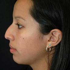 before rhinoplasty left side view of female patient 2959
