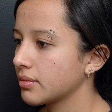 after rhinoplasty left angle view of female patient 2959