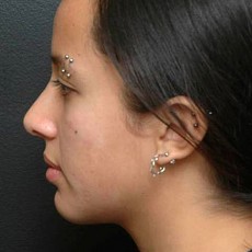 after rhinoplasty left side view of female patient 2959