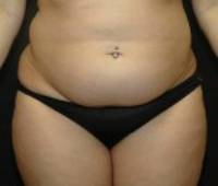 Before tummy tuck front view female patient case 2752