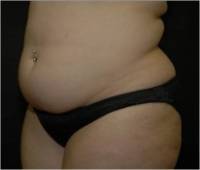 Before tummy tuck left angle view female patient case 2752