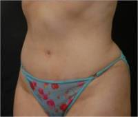 After tummy tuck left angle view female patient case 2752