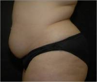 Before tummy tuck left side view female patient case 2752