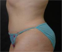 After tummy tuck left side view female patient case 2752