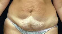 Before tummy tuck front view female patient case 2759