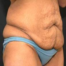 Before tummy tuck right angle view female patient case 2764