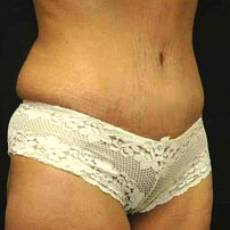 After tummy tuck right angle view female patient case 2764