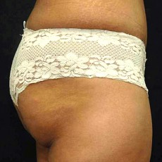 After tummy tuck right side view female patient case 2764