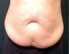 Before tummy tuck front view female patient case 2769