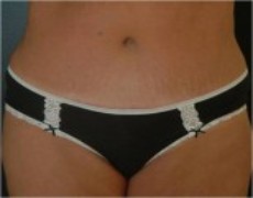 After tummy tuck front view female patient case 2769