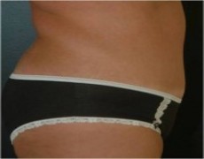 After tummy tuck side view female patient case 2769