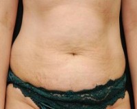 Before tummy tuck front view female patient case 2774